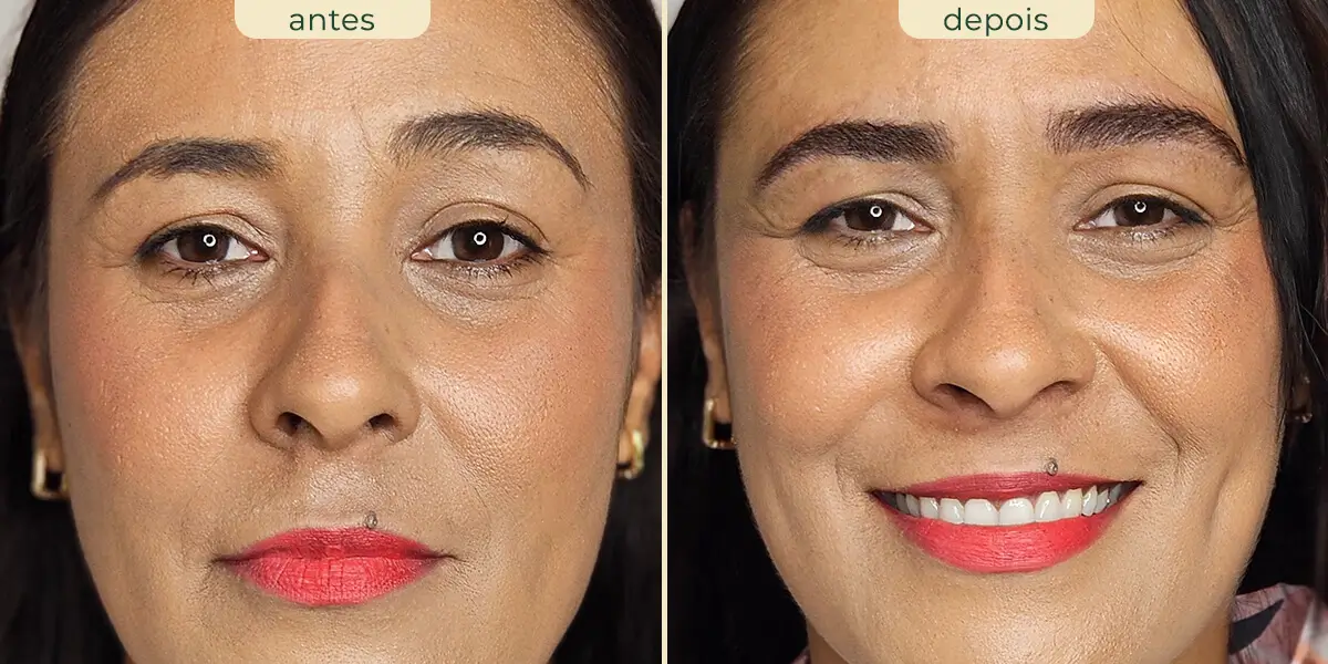 foto comparativa antes e depois do procedimento nanopigmentação de sobrancelhas feito em mulher morena com aparentemente 45 anos.